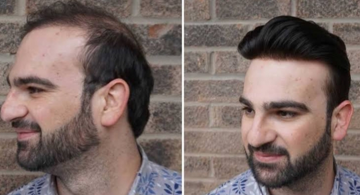 Men Hair Replacement - new thing anymore